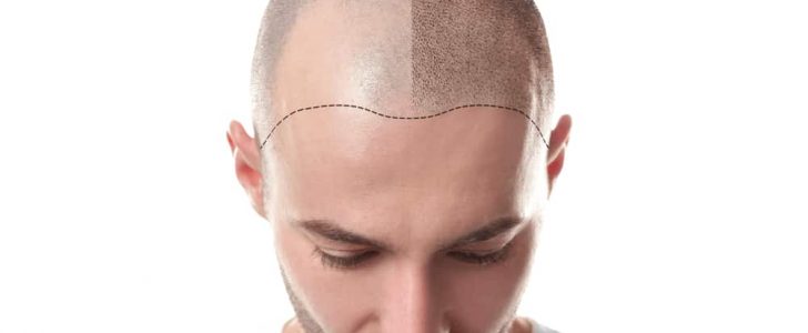 أهم الأسباب التي جعلت تركيا الوجهة الأولى لعمليات زراعة الشعر